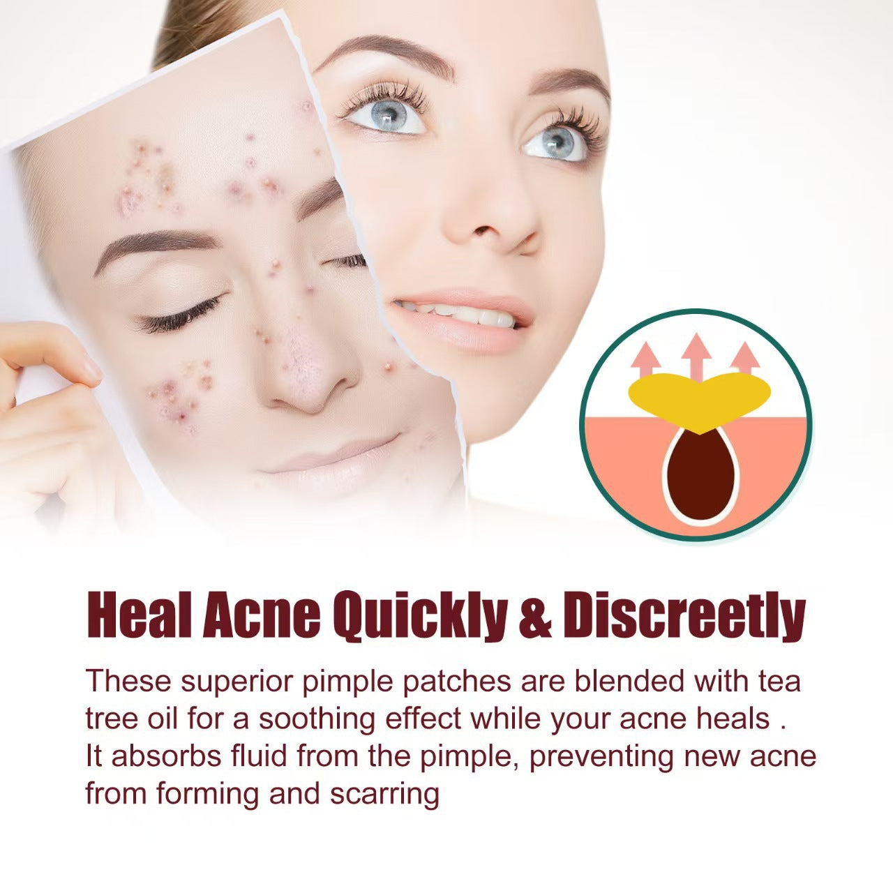 Hydrocolloid Acne Patches
