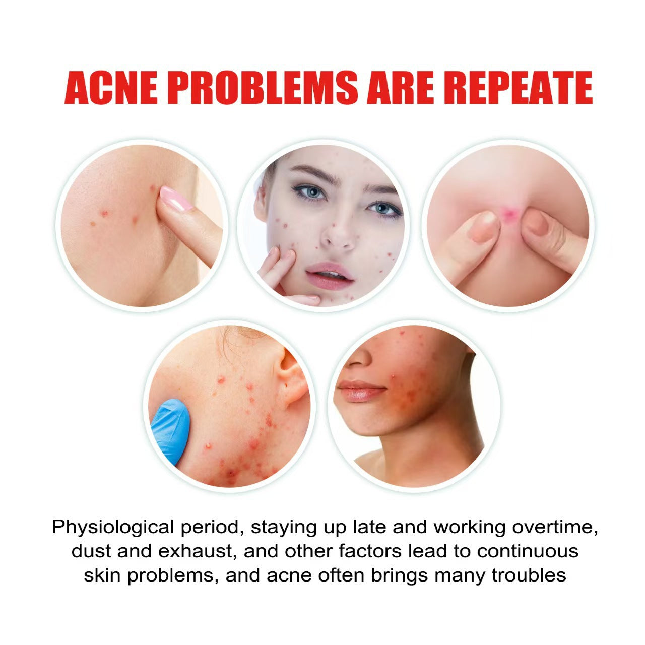 Hydrocolloid Acne Patches